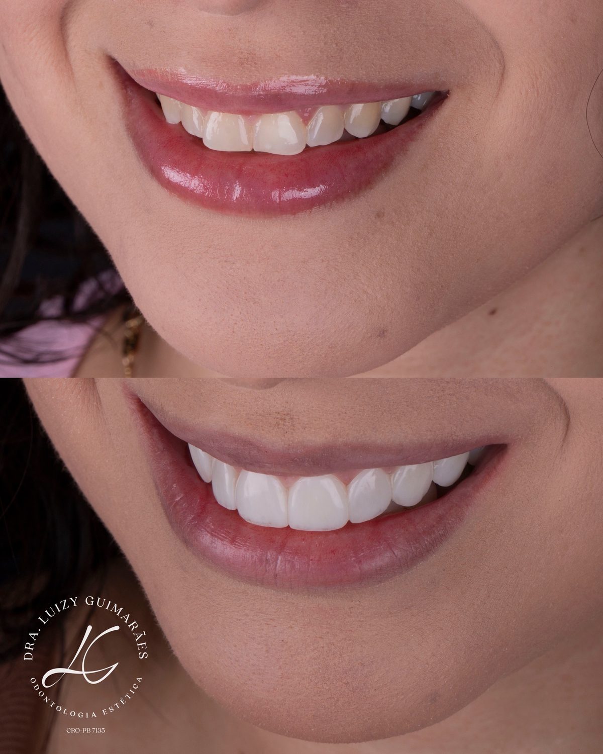 Antes e depois de facetas de resina — sorriso lateral