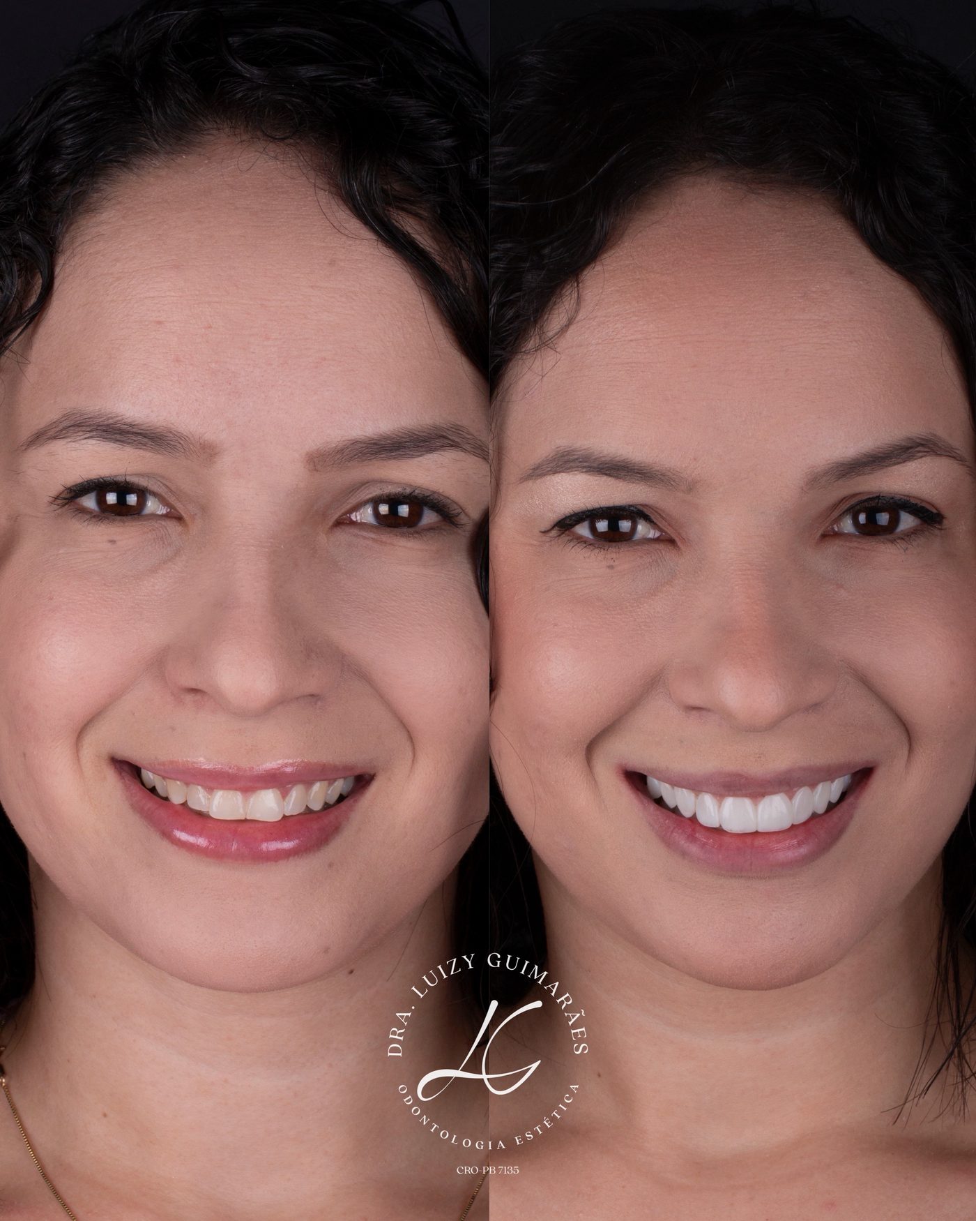 Antes e depois de facetas de resina — rosto completo